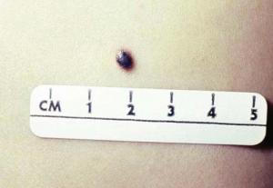 Blue mole, 4 types of skin moles by healthista.com