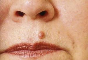 Intradermal mole, 4 types of skin moles by healthista.com