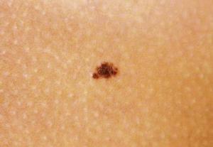 Junctional mole, 4 types of skin moles by healthista.com
