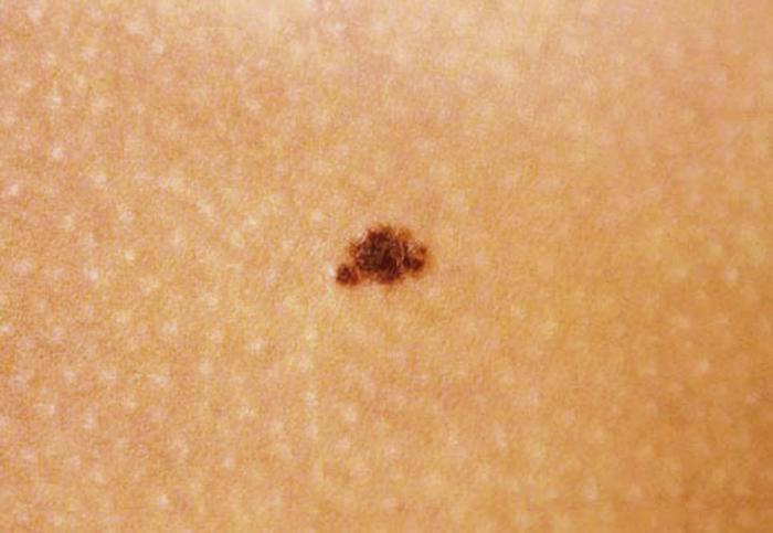 Melanocytic nevus of trunk (Concept Id: C0349066)