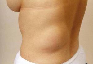 Lipoma, 4 types of skin moles by healthista.com