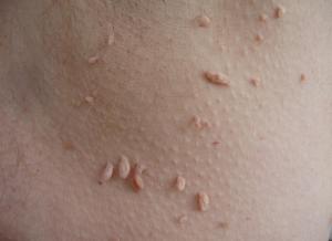 Skin tags, 4 types of moles by healthista.com
