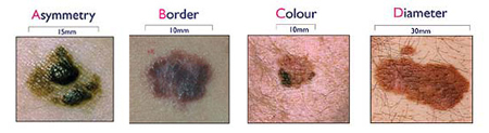 ABCD moles
