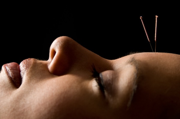 Acupuncture