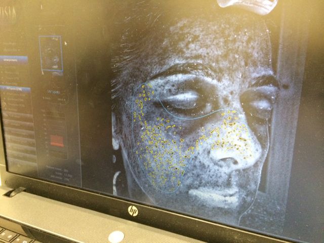 VISIA 4 SUN DAMAGE