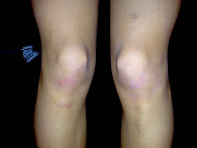 Bruised legs, The new extreme fit, by Healthista.com