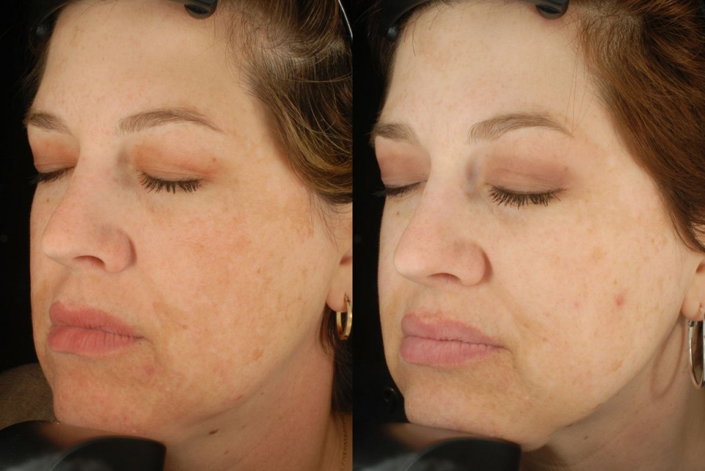 One of the before and after pictures from an Epionce trial