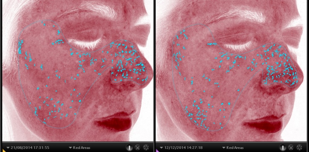 Redness in the skin also improved