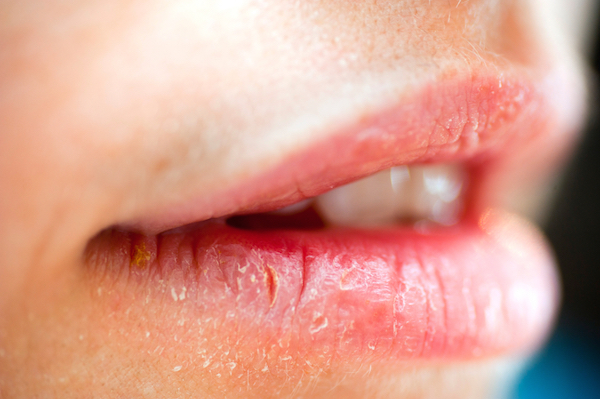 cracked lips, by Healthista.com