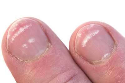 white spots on nails, by Healthista.com