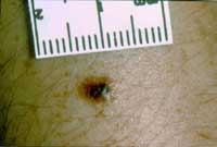 Melanoma w irregular shape and color, 4 types of skin moes by healthista.com