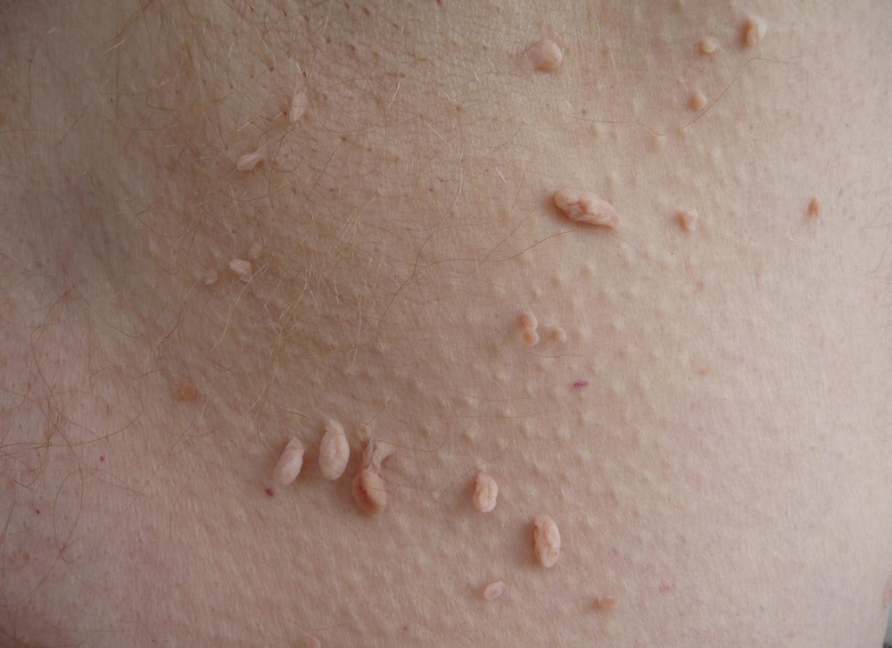 Skin tags, 4 types of moles by healthista.com