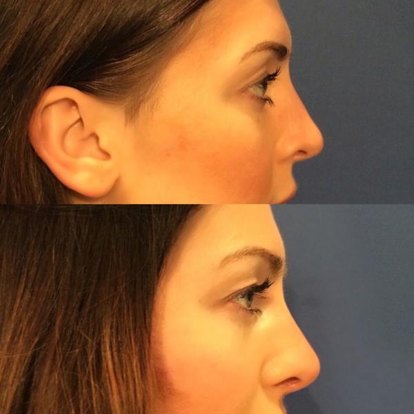 non-surgical nose job a.k.a a ’15 minute nose job’ .