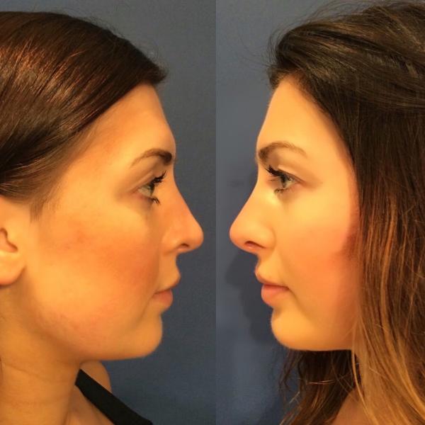 non-surgical the subtle nose job by healthista