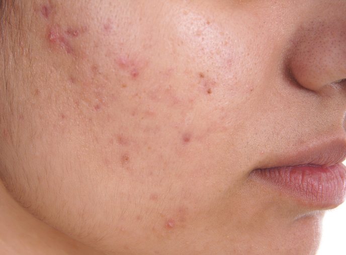 BEST-foods-to-eat-and-foods-to-avoid-for-top-12-common-ailments-acne