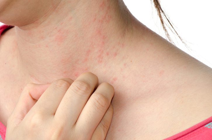 BEST-foods-to-eat-and-foods-to-avoid-for-top-12-common-ailments-eczema