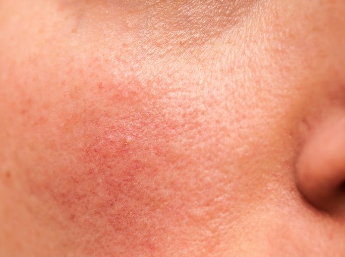 BEST-foods-to-eat-and-foods-to-avoid-for-top-12-common-ailments-rosacea