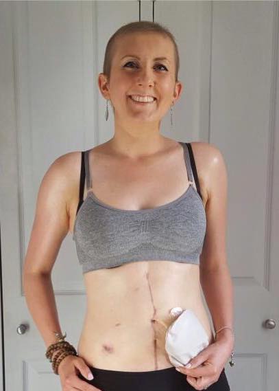 Fiona Munro, My bloating turned out to be ovarian cancer at the age of 30, by healthista (9)