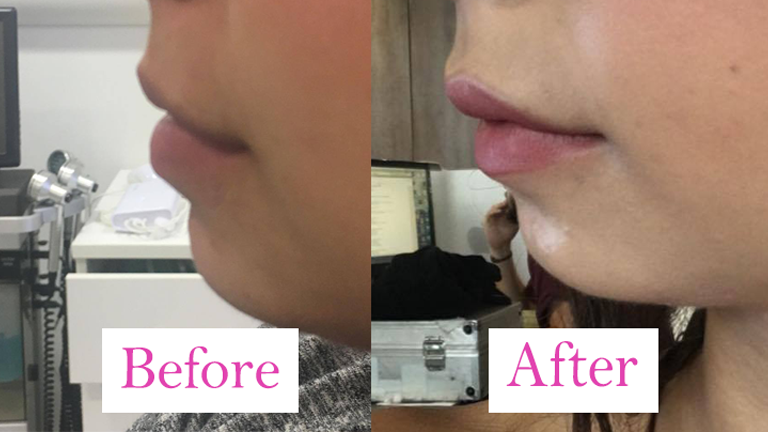 main before and after lip fillers, I got lip fillers and this is what happened by healthista