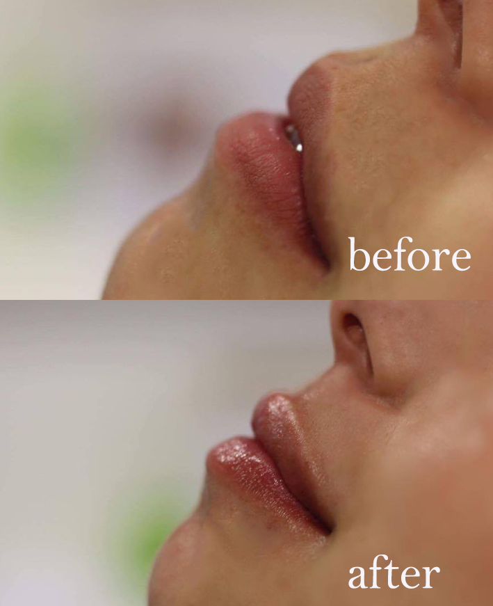 Karidis lip fillers side view before and after, I had lip fillers by healthista