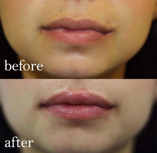 before and after Karidis front view, what happened when I had lip fillers by healthista