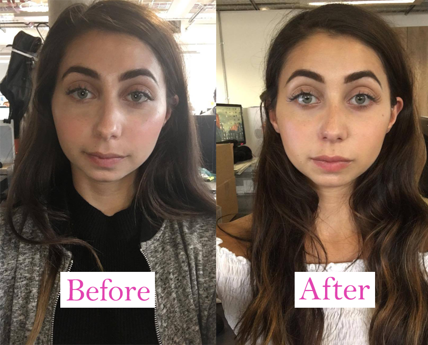 before and after full face 2, I got lip fillers and this is what happened by healthista