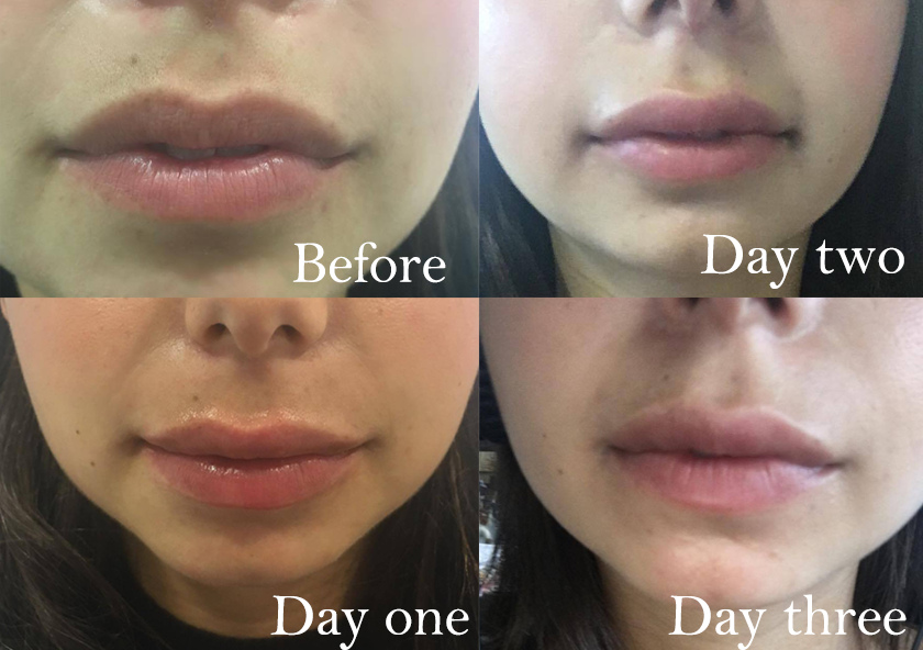 three days transformation, I got lip fillers and this is what happened by healthista