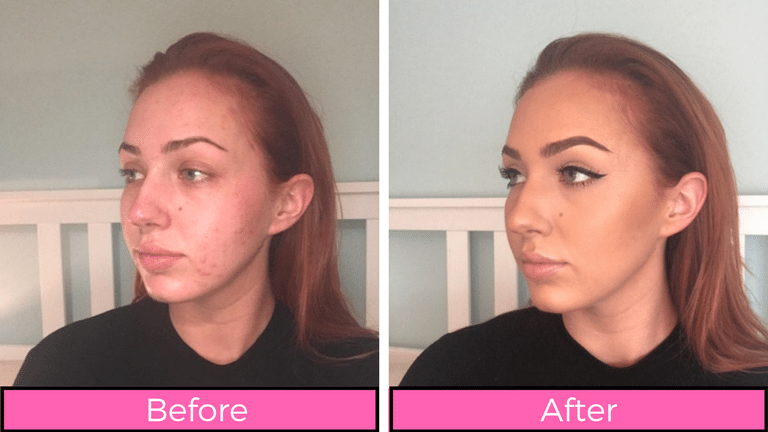 Before and after 19 beauty products this makeup artist with psoriasis swears by healthista main