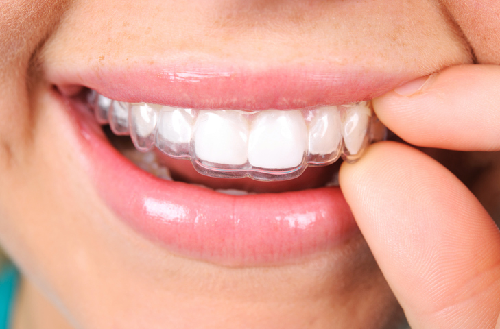 Retainer invisalign how to get straight teeth orthodontists guide 