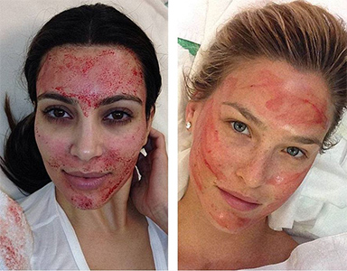 The Vampire facelift t... Kim Kardashian Pregnancy 2018
