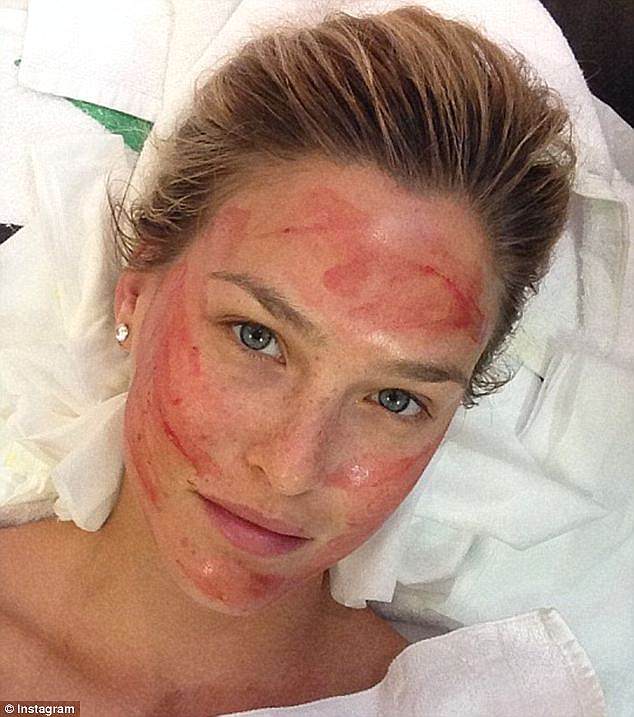 bar Refaeli vampire facelift post instagram