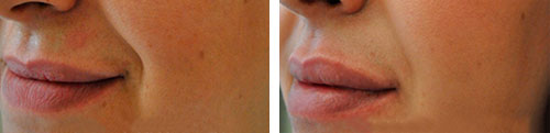 before-and-after-lip-fillers,-what-are-lip-fillers--Ask-the-dermatologist-by-healthista.com