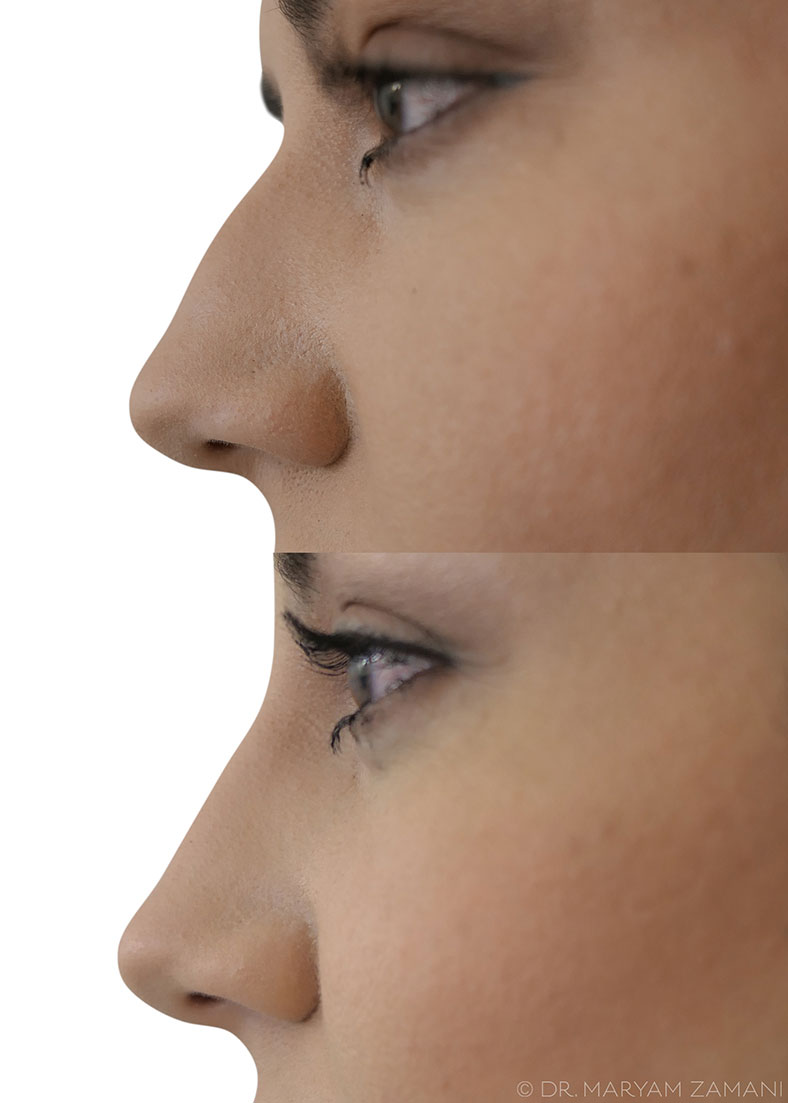 before-and-after-nose-filler,-what-are-nose-fillers--ask-the-dermatologist-by-healthista.com