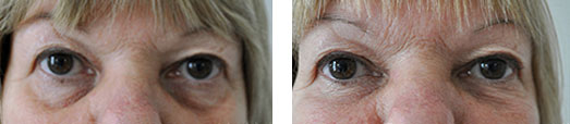 before-and-after-tear-trough-fillers,-what-are-tear-trough-fillers,-ask-the-anti-ageing-doctor-by-healthista.com