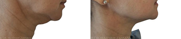 before-and-after-ultherapy,-ask-the-anti-ageing-doctor-by-healthista.com