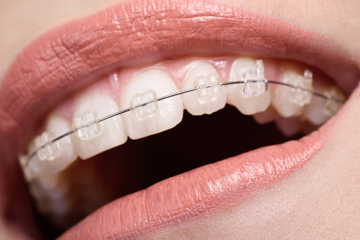 teeth with braces how to get straight teeth orthodontists guide 