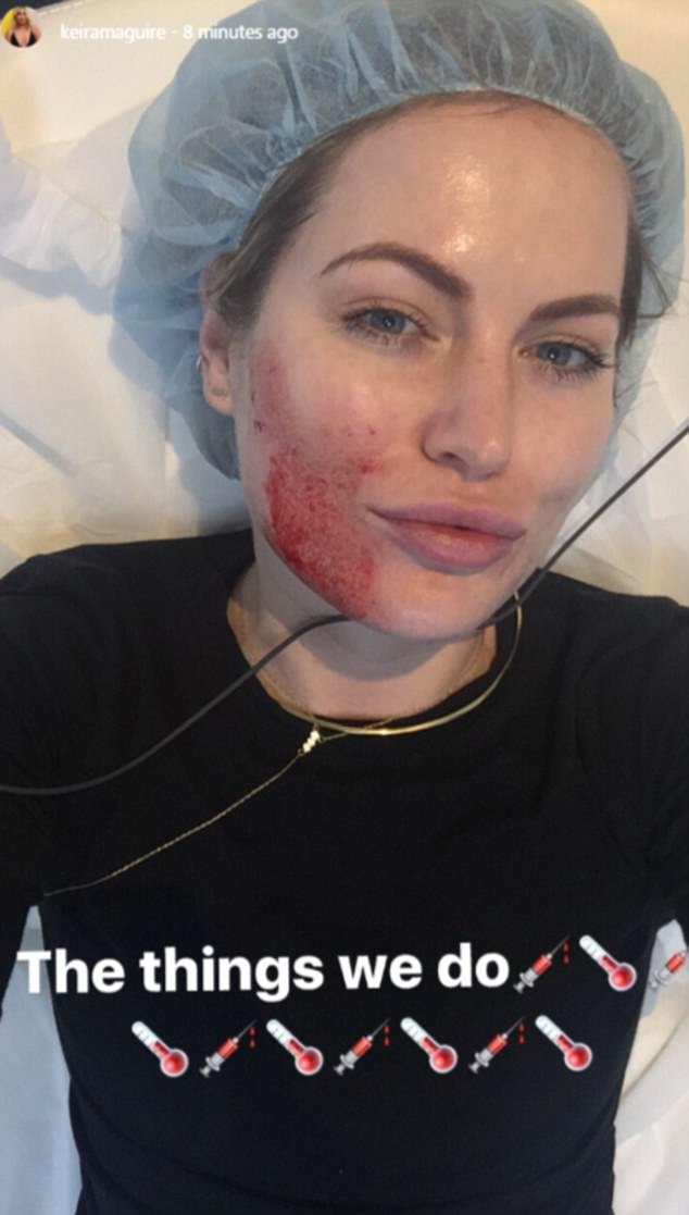 kiera maquire vampire facelift instagram story