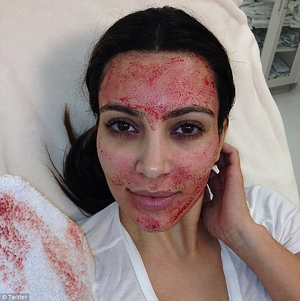 kim kardashian vampire facial post