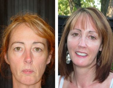 Maureen Reene Before and After Feature non-surgical filler face lift