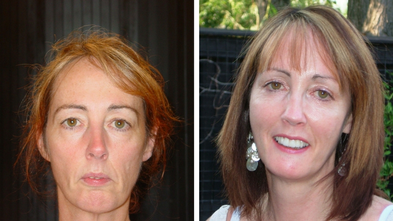 Maureen Reene Before and After Feature non-surgical filler face lift