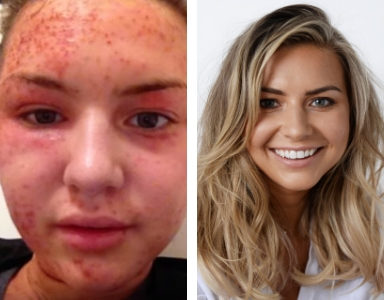 How I finally conquered my lifelong battle with eczema FEATURE