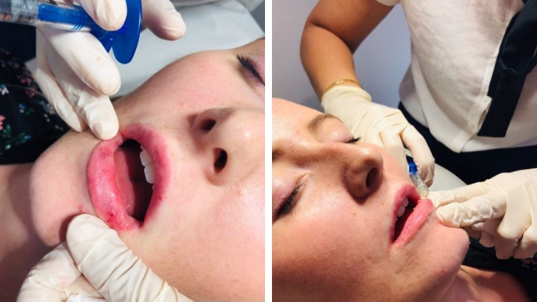 Lip fillers