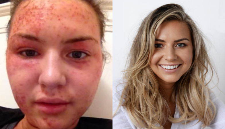 eczema how i conquered it before and after