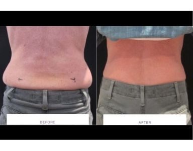 Fat freezing before and after FEATURED