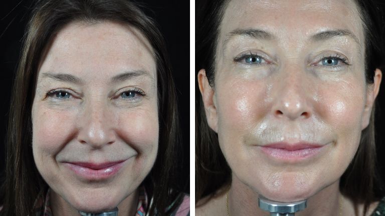 profhilo beauty jab - front before and after - main