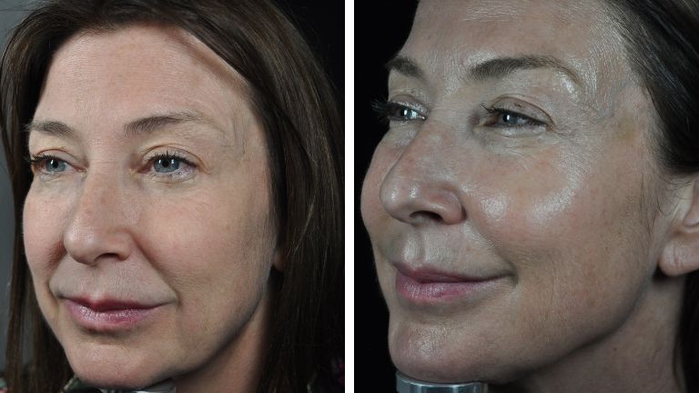 profhilo beauty jab - sharon side before and after