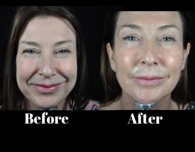 profhilo sharon before and after - featured