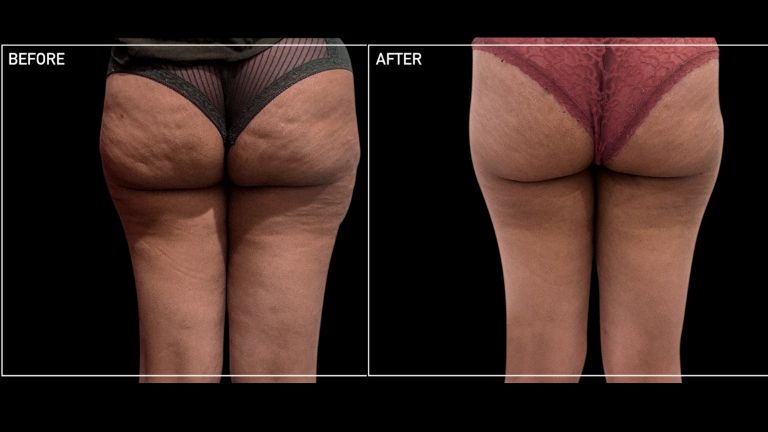 The simple solution to cellulite- My experience with Cellfina MAIN