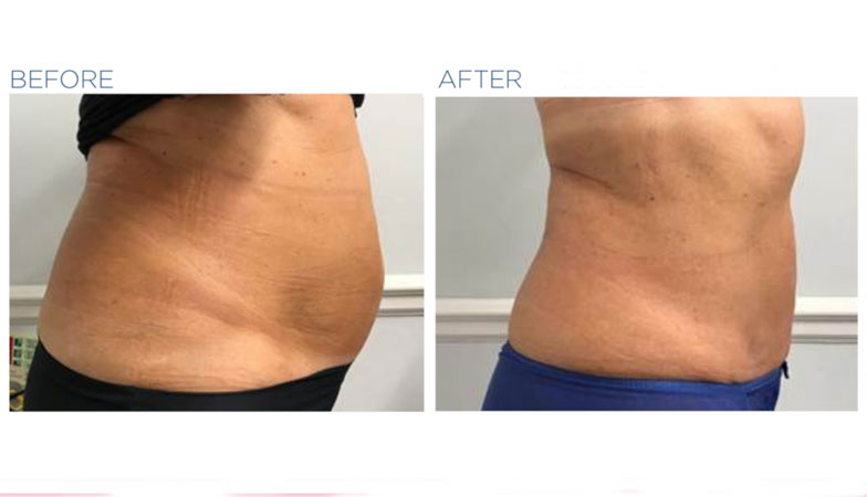 flat before-and-after-treatment-image-emsculpt-by-healthista.com