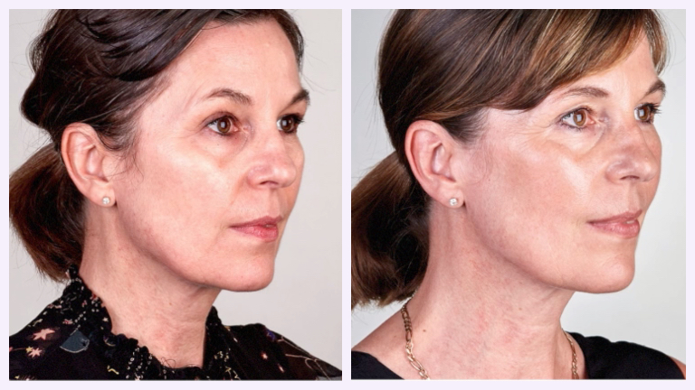 main ultherapy before and after healthista